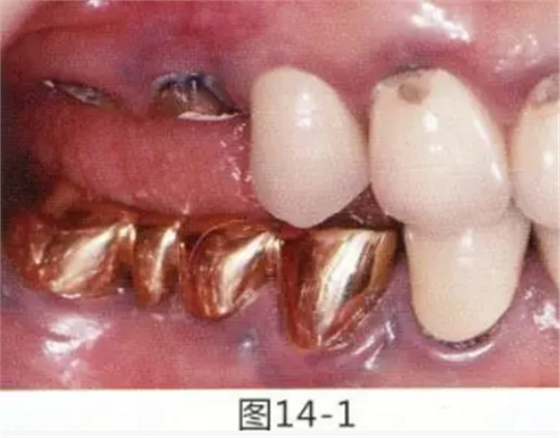 FGG法增大附著齦及根面覆蓋【牙齦-牙槽黏膜的問題】 FGG法增大附著齦及根面覆蓋【牙齦-牙槽黏膜的問題】