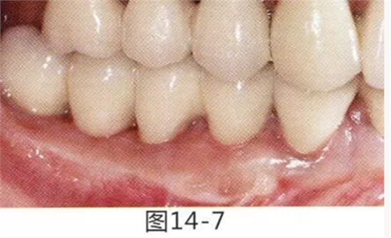 FGG法增大附著齦及根面覆蓋【牙齦-牙槽黏膜的問題】 FGG法增大附著齦及根面覆蓋【牙齦-牙槽黏膜的問題】