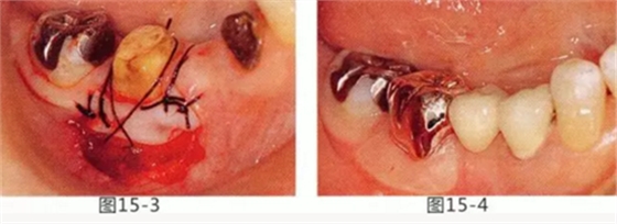 FGG法增大附著齦及根面覆蓋【牙齦-牙槽黏膜的問題】 FGG法增大附著齦及根面覆蓋【牙齦-牙槽黏膜的問題】