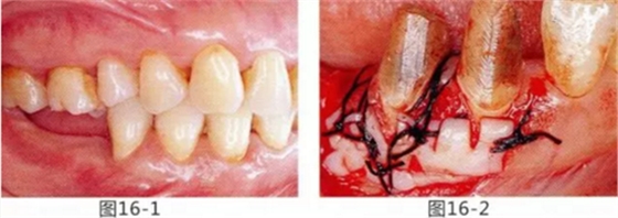 FGG法增大附著齦及根面覆蓋【牙齦-牙槽黏膜的問題】 FGG法增大附著齦及根面覆蓋【牙齦-牙槽黏膜的問題】