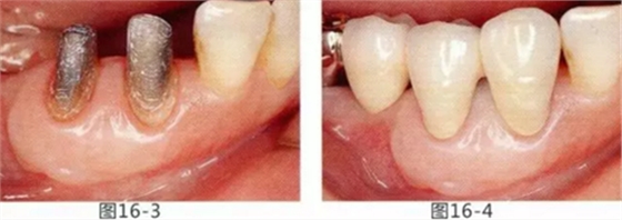 FGG法增大附著齦及根面覆蓋【牙齦-牙槽黏膜的問題】 FGG法增大附著齦及根面覆蓋【牙齦-牙槽黏膜的問題】