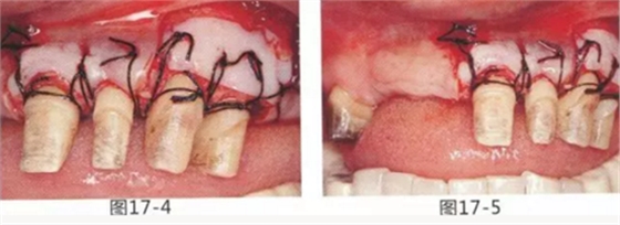 FGG法增大附著齦及根面覆蓋【牙齦-牙槽黏膜的問題】 FGG法增大附著齦及根面覆蓋【牙齦-牙槽黏膜的問題】