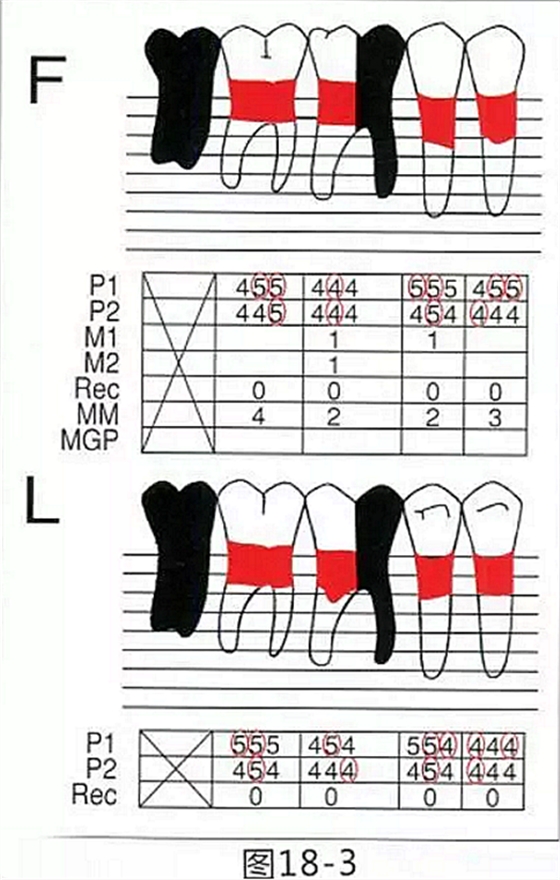 FGG法增大附著齦及根面覆蓋【牙齦-牙槽黏膜的問題】 FGG法增大附著齦及根面覆蓋【牙齦-牙槽黏膜的問題】