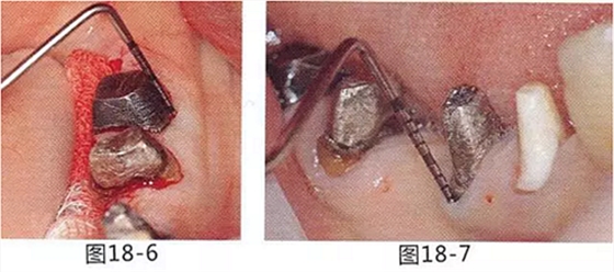 FGG法增大附著齦及根面覆蓋【牙齦-牙槽黏膜的問題】 FGG法增大附著齦及根面覆蓋【牙齦-牙槽黏膜的問題】