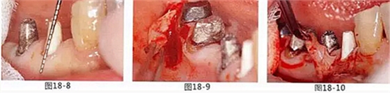 FGG法增大附著齦及根面覆蓋【牙齦-牙槽黏膜的問題】 FGG法增大附著齦及根面覆蓋【牙齦-牙槽黏膜的問題】
