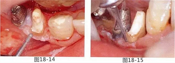 FGG法增大附著齦及根面覆蓋【牙齦-牙槽黏膜的問題】 FGG法增大附著齦及根面覆蓋【牙齦-牙槽黏膜的問題】