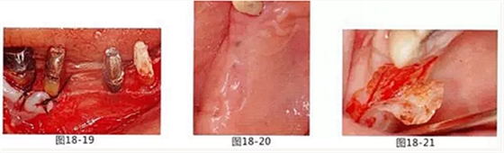 FGG法增大附著齦及根面覆蓋【牙齦-牙槽黏膜的問題】 FGG法增大附著齦及根面覆蓋【牙齦-牙槽黏膜的問題】