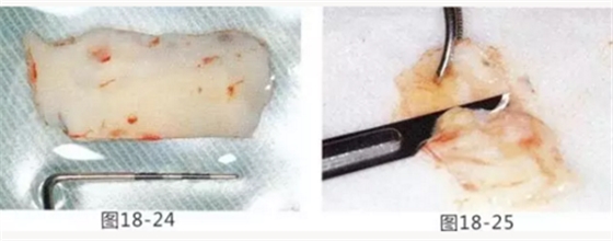 FGG法增大附著齦及根面覆蓋【牙齦-牙槽黏膜的問題】 FGG法增大附著齦及根面覆蓋【牙齦-牙槽黏膜的問題】