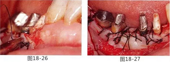 FGG法增大附著齦及根面覆蓋【牙齦-牙槽黏膜的問題】 FGG法增大附著齦及根面覆蓋【牙齦-牙槽黏膜的問題】