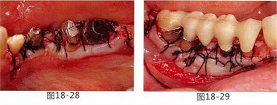 FGG法增大附著齦及根面覆蓋【牙齦-牙槽黏膜的問題】 FGG法增大附著齦及根面覆蓋【牙齦-牙槽黏膜的問題】