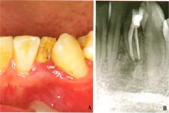 下頜側(cè)切牙Ⅲ型牙內(nèi)陷1例.png 下頜側(cè)切牙Ⅲ型牙內(nèi)陷1例.png