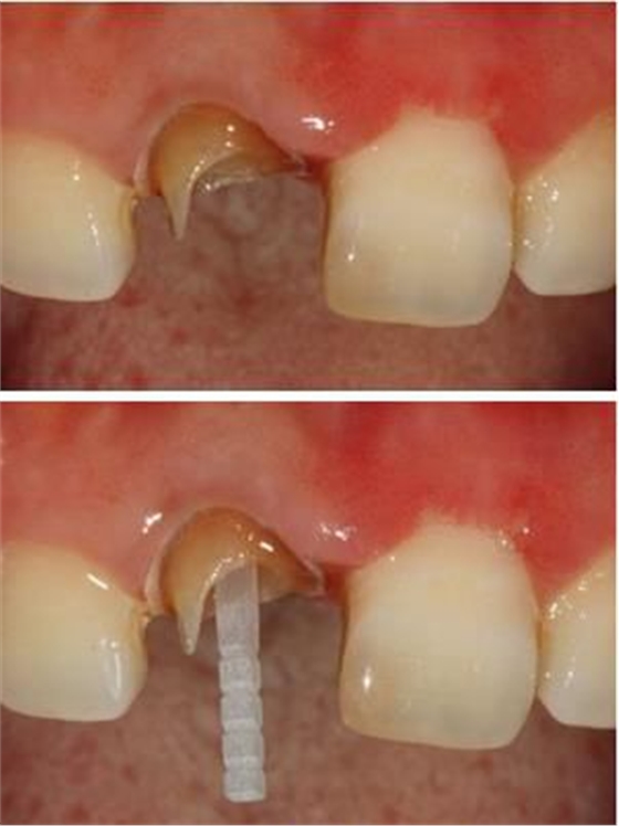纖維樁臨床操作步驟 纖維樁臨床操作步驟