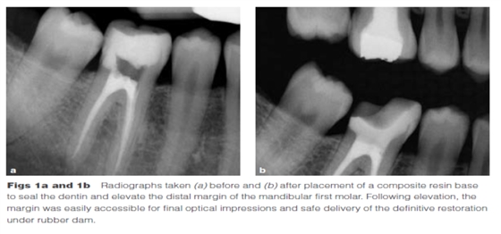 DME: 齦壁提升術(shù) DME: 齦壁提升術(shù)