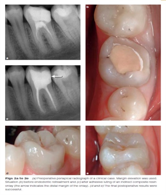 DME: 齦壁提升術(shù) DME: 齦壁提升術(shù)