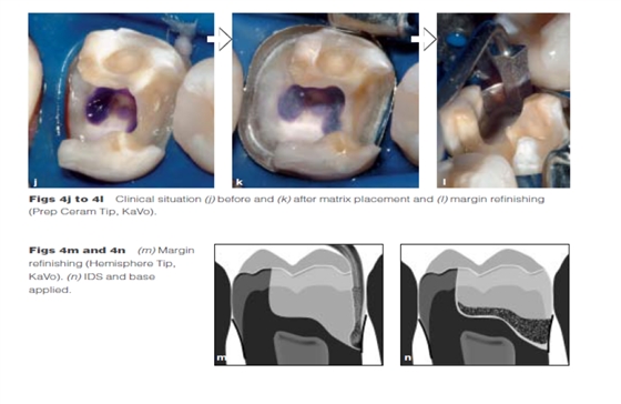 DME: 齦壁提升術(shù) DME: 齦壁提升術(shù)