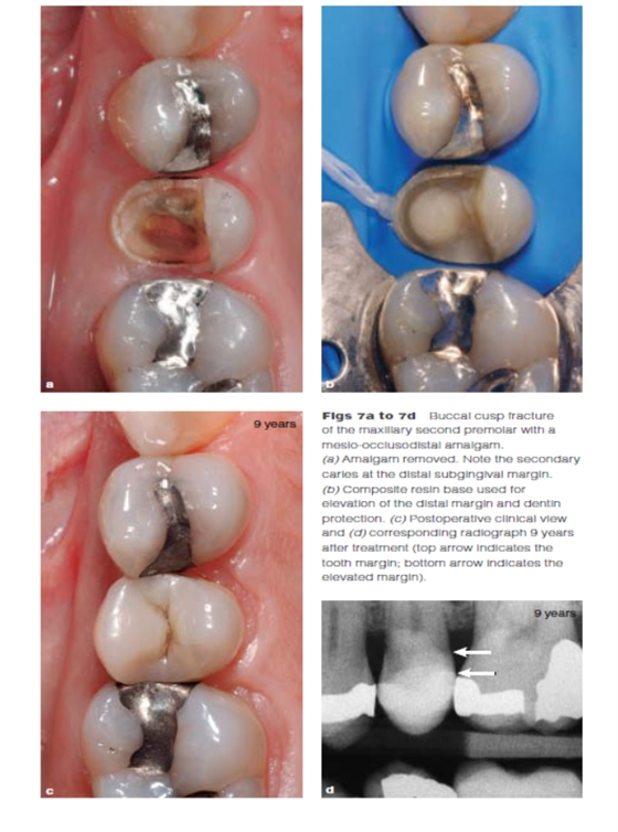 DME: 齦壁提升術(shù) DME: 齦壁提升術(shù)