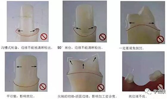 影響全瓷牙冠裂的因素有哪些？