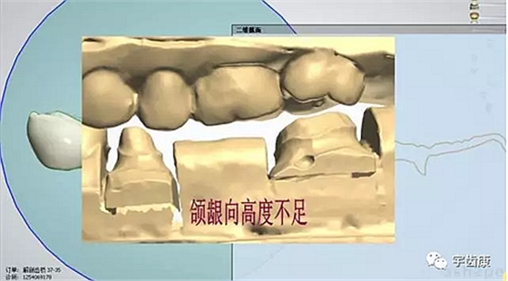 影響全瓷牙冠裂的因素有哪些？