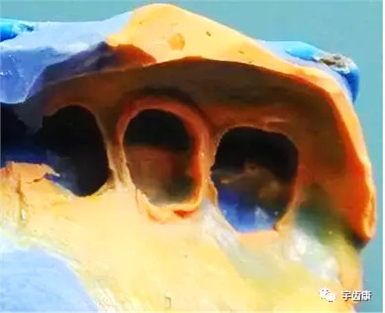 影響全瓷牙冠裂的因素有哪些？