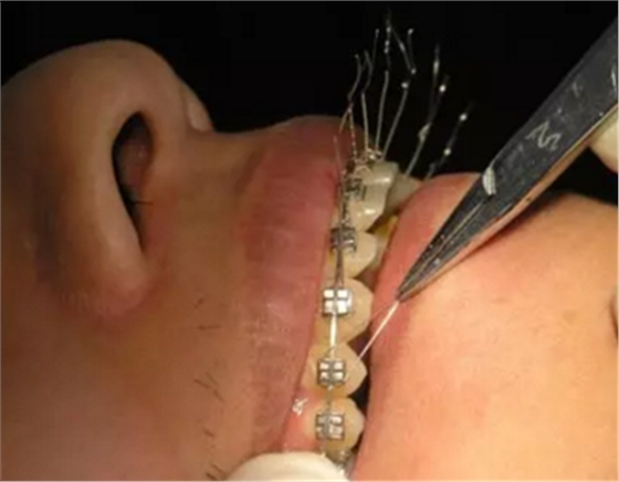 弓絲結(jié)扎及扎絲末端處理技巧 弓絲結(jié)扎及扎絲末端處理技巧