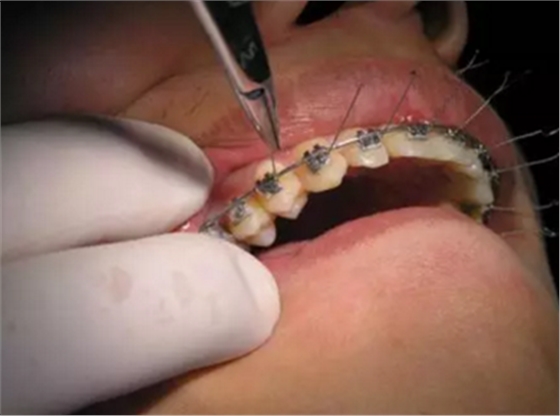 弓絲結(jié)扎及扎絲末端處理技巧 弓絲結(jié)扎及扎絲末端處理技巧