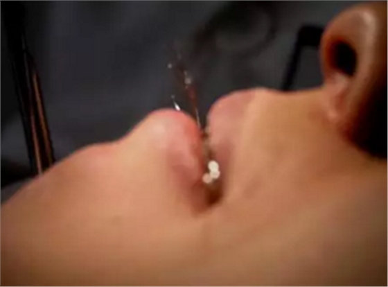 弓絲結(jié)扎及扎絲末端處理技巧 弓絲結(jié)扎及扎絲末端處理技巧