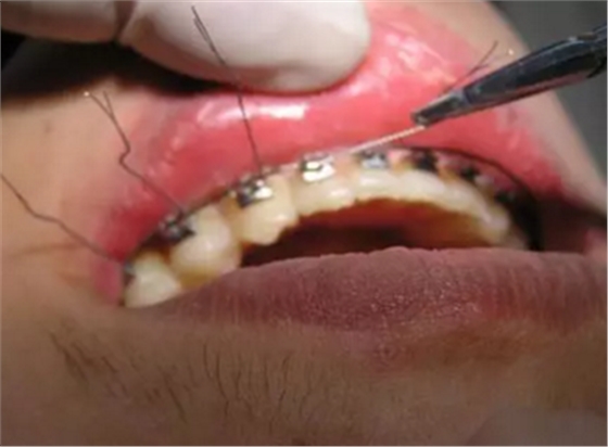 弓絲結(jié)扎及扎絲末端處理技巧 弓絲結(jié)扎及扎絲末端處理技巧