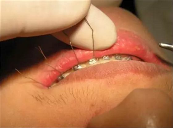 弓絲結(jié)扎及扎絲末端處理技巧 弓絲結(jié)扎及扎絲末端處理技巧