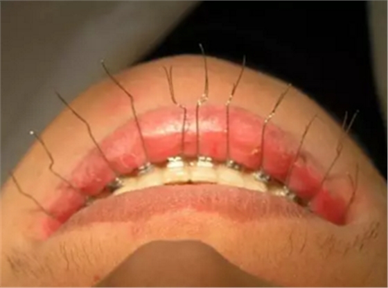 弓絲結(jié)扎及扎絲末端處理技巧 弓絲結(jié)扎及扎絲末端處理技巧