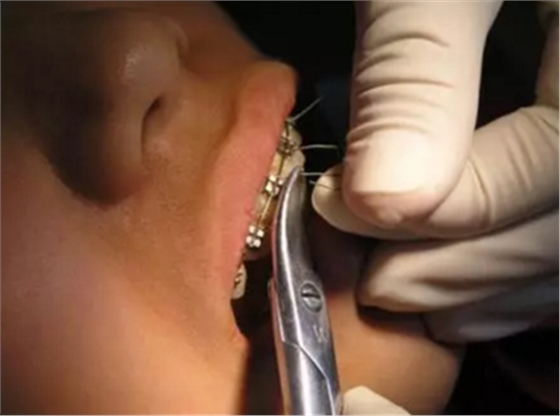 弓絲結(jié)扎及扎絲末端處理技巧 弓絲結(jié)扎及扎絲末端處理技巧