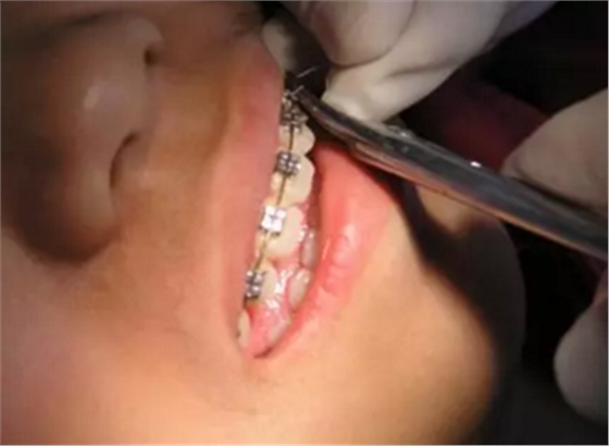 弓絲結(jié)扎及扎絲末端處理技巧 弓絲結(jié)扎及扎絲末端處理技巧