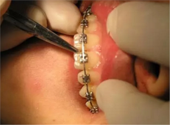 弓絲結(jié)扎及扎絲末端處理技巧 弓絲結(jié)扎及扎絲末端處理技巧