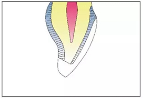 全瓷修復(fù)體貼面的制備 全瓷修復(fù)體貼面的制備