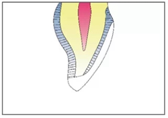 全瓷修復(fù)體貼面的制備 全瓷修復(fù)體貼面的制備