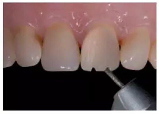 全瓷修復(fù)體貼面的制備 全瓷修復(fù)體貼面的制備