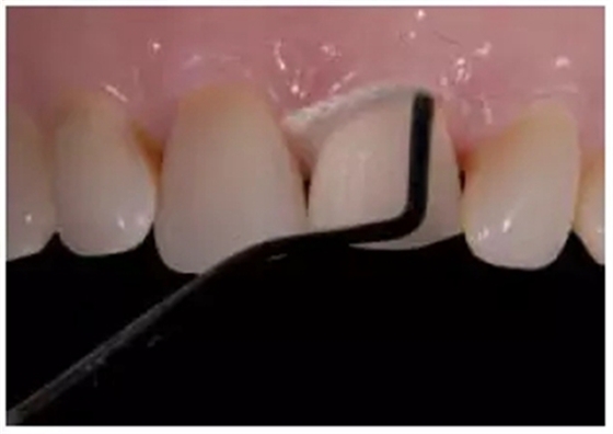 全瓷修復(fù)體貼面的制備 全瓷修復(fù)體貼面的制備