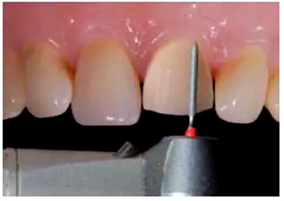 全瓷修復(fù)體貼面的制備 全瓷修復(fù)體貼面的制備