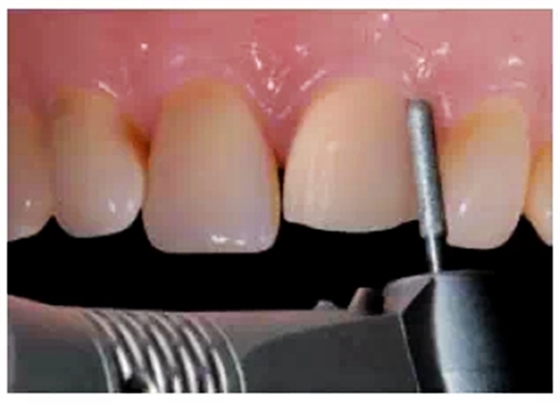 全瓷修復(fù)體貼面的制備 全瓷修復(fù)體貼面的制備