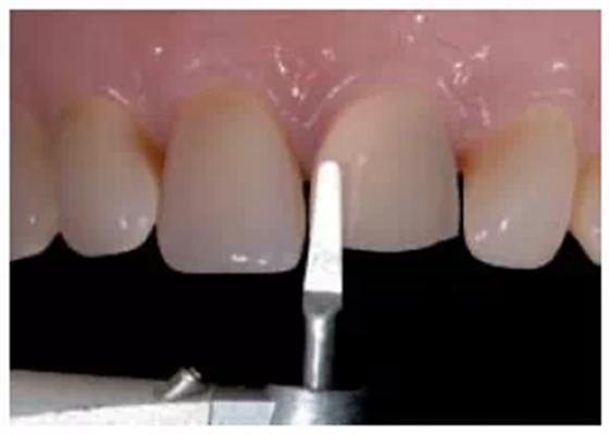 全瓷修復(fù)體貼面的制備 全瓷修復(fù)體貼面的制備