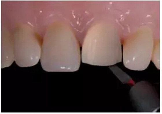 全瓷修復(fù)體貼面的制備 全瓷修復(fù)體貼面的制備