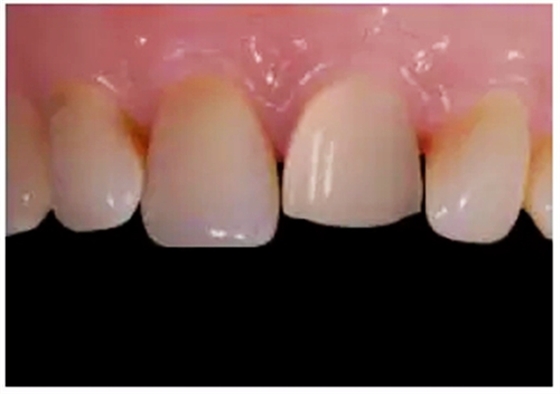 全瓷修復(fù)體貼面的制備 全瓷修復(fù)體貼面的制備