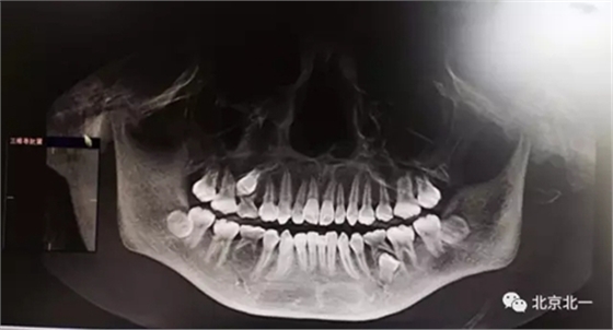 微創(chuàng)舒適拔埋伏牙病 微創(chuàng)舒適拔埋伏牙病