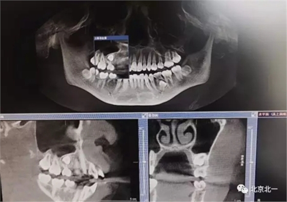 微創(chuàng)舒適拔埋伏牙病 微創(chuàng)舒適拔埋伏牙病