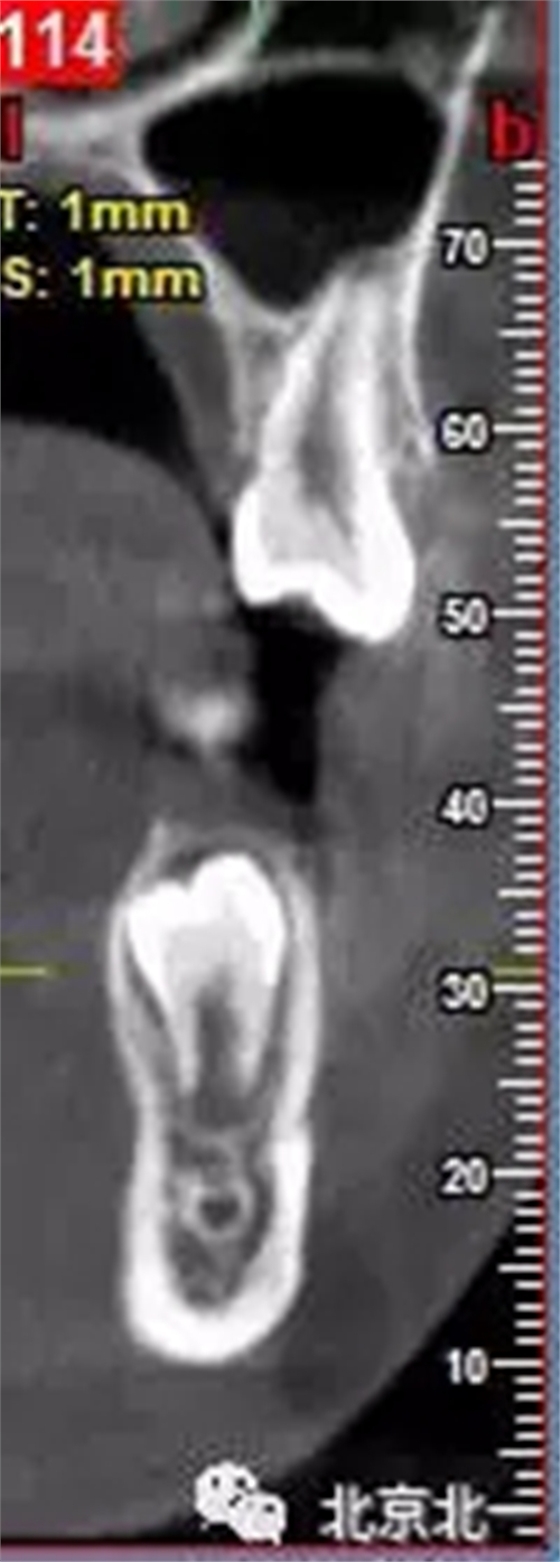 微創(chuàng)舒適拔埋伏牙病 微創(chuàng)舒適拔埋伏牙病