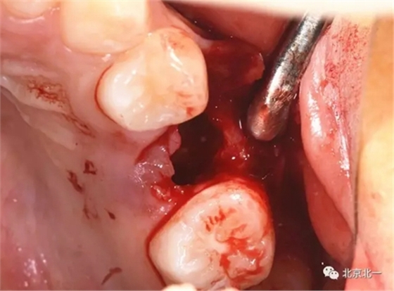 微創(chuàng)舒適拔埋伏牙病 微創(chuàng)舒適拔埋伏牙病