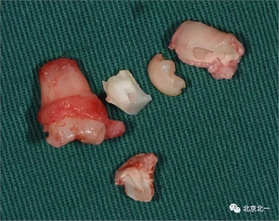 微創(chuàng)舒適拔埋伏牙病 微創(chuàng)舒適拔埋伏牙病