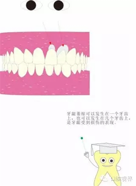 【愛牙科普知識(shí)300問】 “什么是牙齦萎縮？”