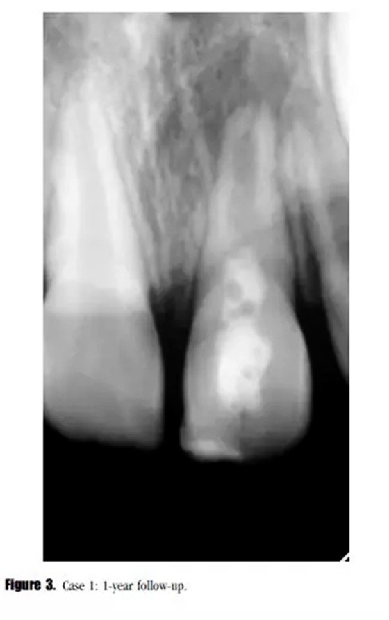 病例分享|牙髓血管再生治療失敗后的牙根發(fā)育:2例 病例分享|牙髓血管再生治療失敗后的牙根發(fā)育:2例