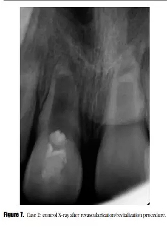 病例分享|牙髓血管再生治療失敗后的牙根發(fā)育:2例 病例分享|牙髓血管再生治療失敗后的牙根發(fā)育:2例
