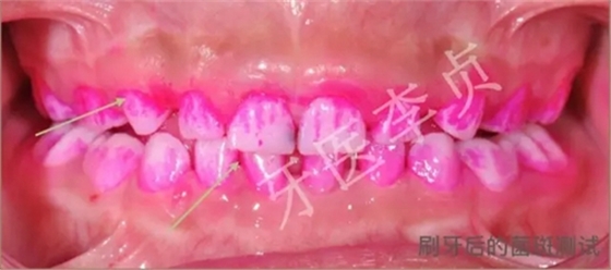 兒牙病例|兒童蛀牙的修復 兒牙病例|兒童蛀牙的修復